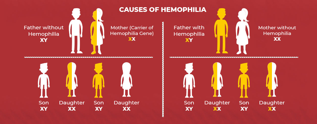 causes of hemophilia